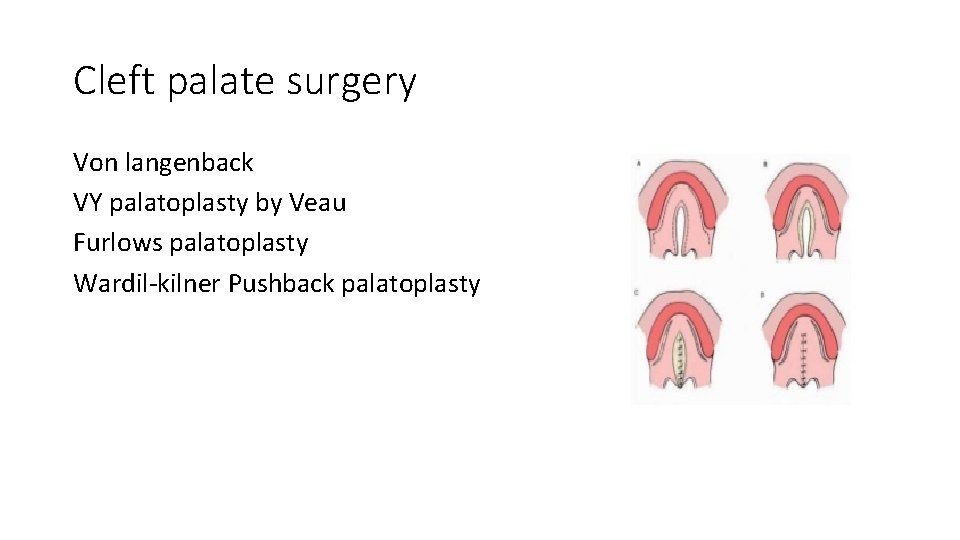 Cleft palate surgery Von langenback VY palatoplasty by Veau Furlows palatoplasty Wardil-kilner Pushback palatoplasty