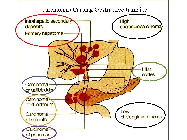 Carcinomas Causing Obstructive Jaundice 