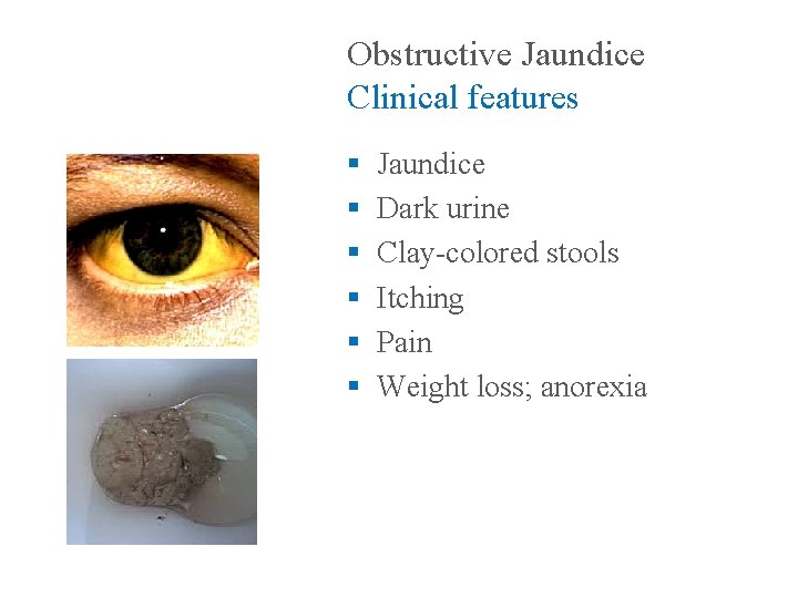 Obstructive Jaundice Clinical features § § § Jaundice Dark urine Clay-colored stools Itching Pain