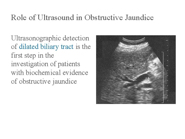 Role of Ultrasound in Obstructive Jaundice Ultrasonographic detection of dilated biliary tract is the