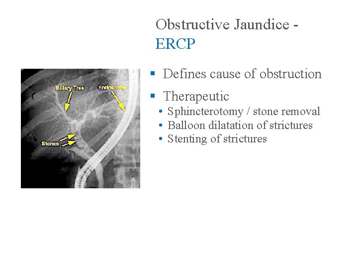 Obstructive Jaundice ERCP § Defines cause of obstruction § Therapeutic • Sphincterotomy / stone