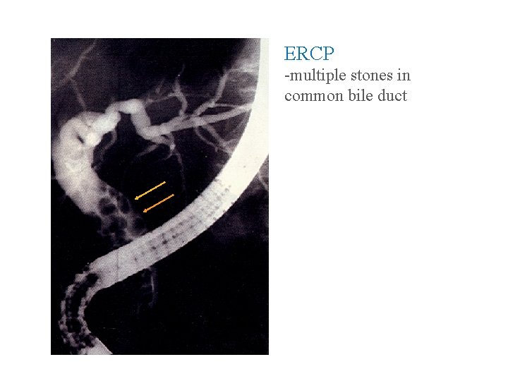 ERCP -multiple stones in common bile duct 