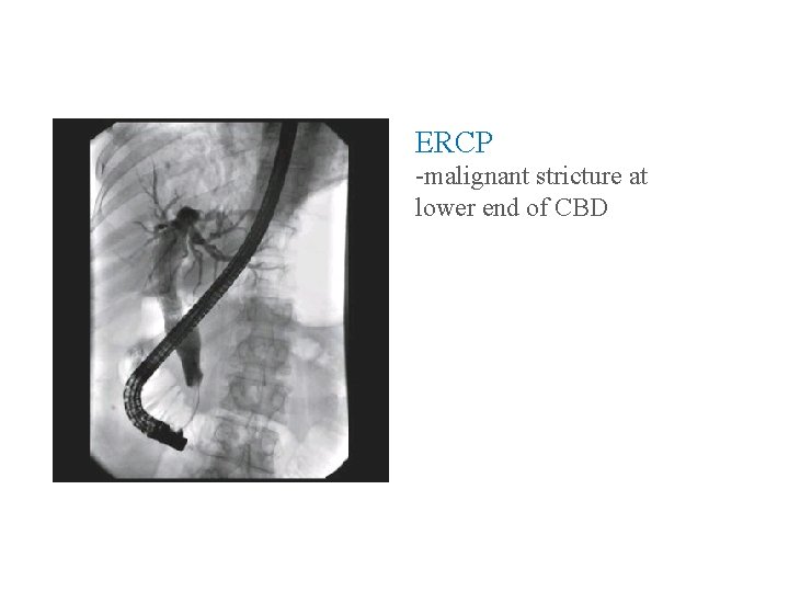 ERCP -malignant stricture at lower end of CBD 