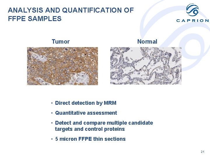 ANALYSIS AND QUANTIFICATION OF FFPE SAMPLES Tumor Normal • Direct detection by MRM •