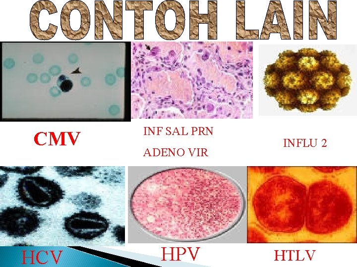 CMV HCV INF SAL PRN ADENO VIR HPV INFLU 2 HTLV 