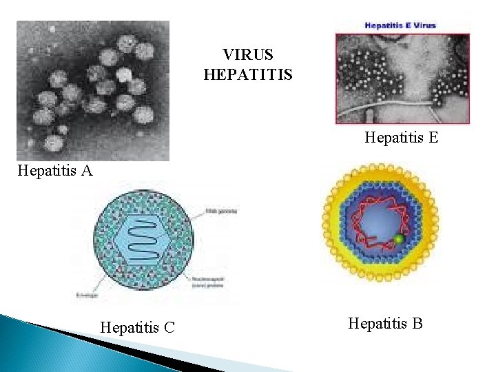 VIRUS HEPATITIS Hepatitis E Hepatitis A Hepatitis C Hepatitis B 