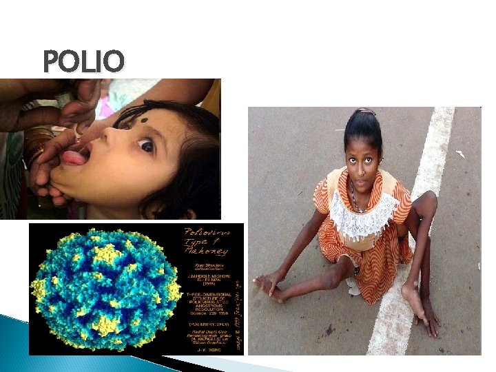 POLIO 