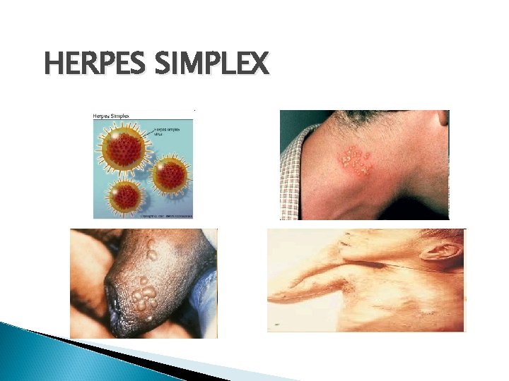 HERPES SIMPLEX 