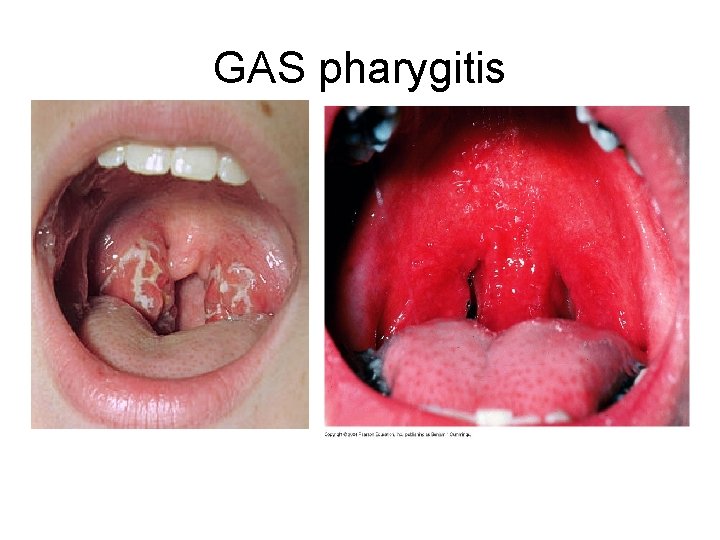 GAS pharygitis GAS pharygitis
