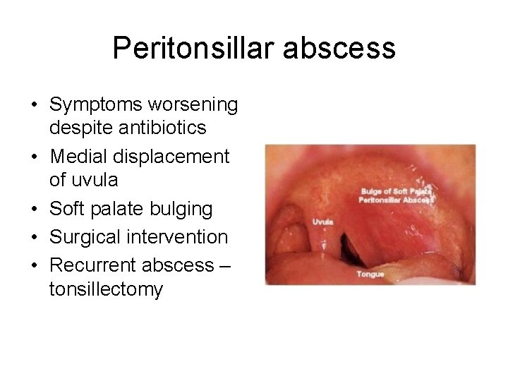 Peritonsillar abscess • Symptoms worsening despite antibiotics • Medial displacement of uvula • Soft Peritonsillar abscess • Symptoms worsening despite antibiotics • Medial displacement of uvula • Soft