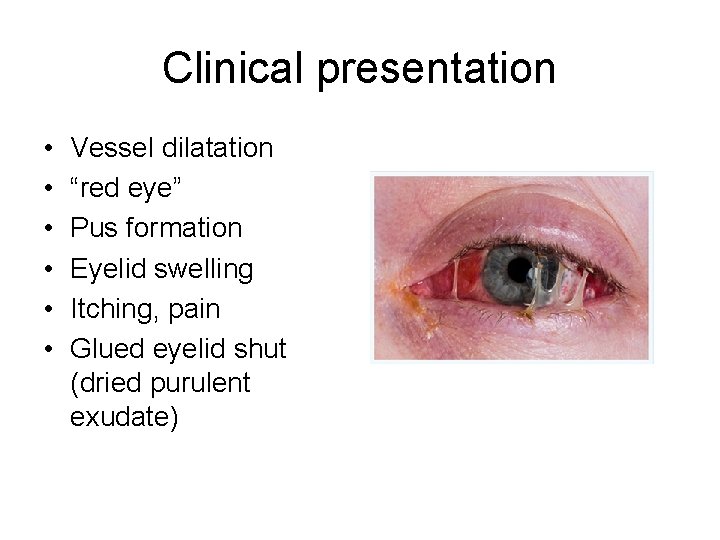 Clinical presentation • • • Vessel dilatation “red eye” Pus formation Eyelid swelling Itching, Clinical presentation • • • Vessel dilatation “red eye” Pus formation Eyelid swelling Itching,