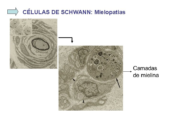 CÉLULAS DE SCHWANN: Mielopatias 