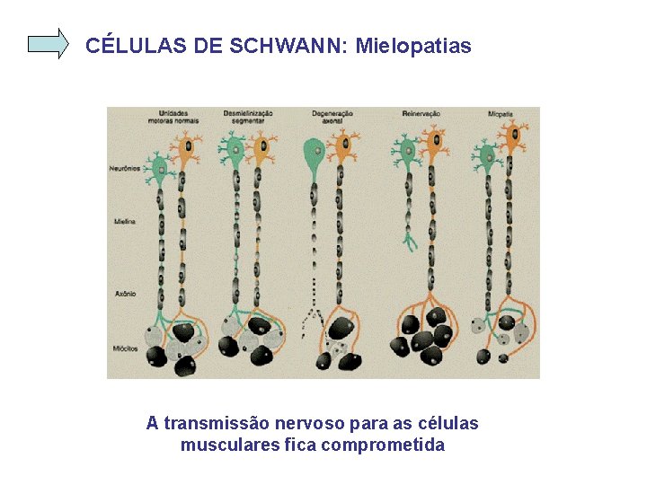 CÉLULAS DE SCHWANN: Mielopatias A transmissão nervoso para as células musculares fica comprometida 