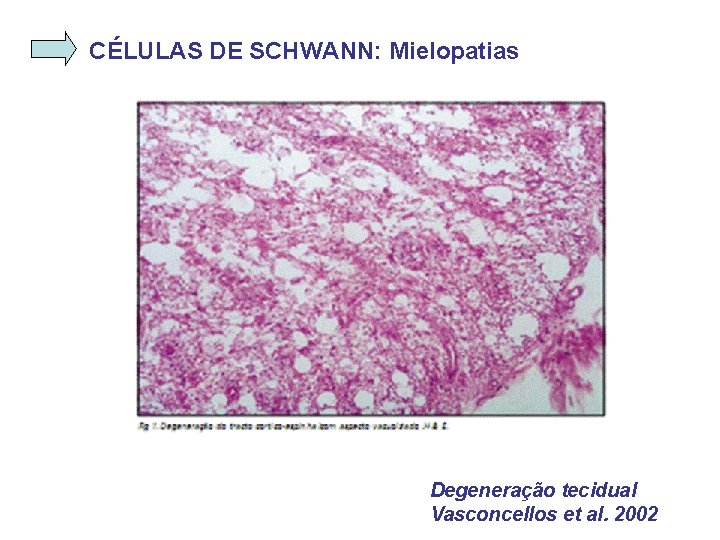 CÉLULAS DE SCHWANN: Mielopatias Degeneração tecidual Vasconcellos et al. 2002 