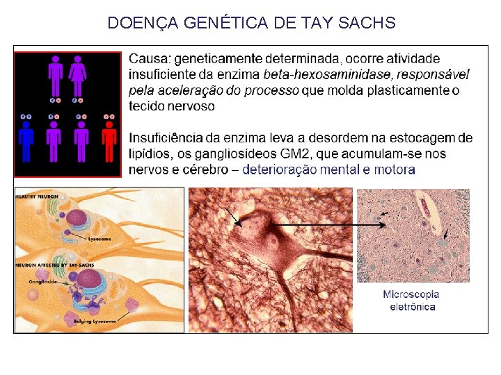 DOENÇA GENÉTICA DE TAY SACHS 