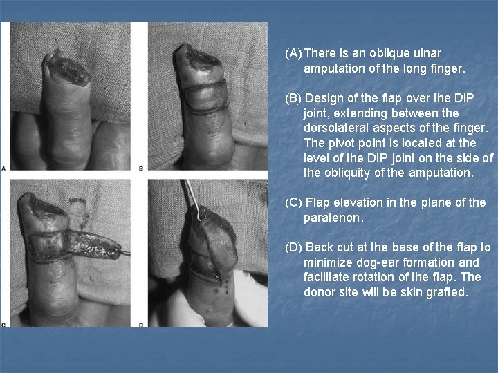 (A) There is an oblique ulnar amputation of the long finger. (B) Design of