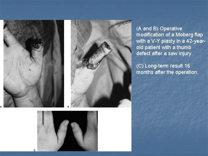 (A and B) Operative modification of a Moberg flap with a V-Y plasty in