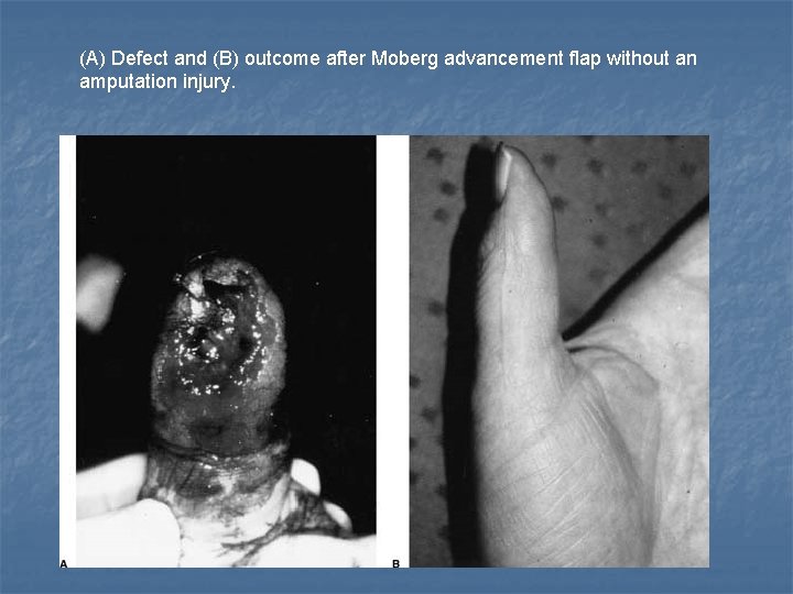 (A) Defect and (B) outcome after Moberg advancement flap without an amputation injury. 