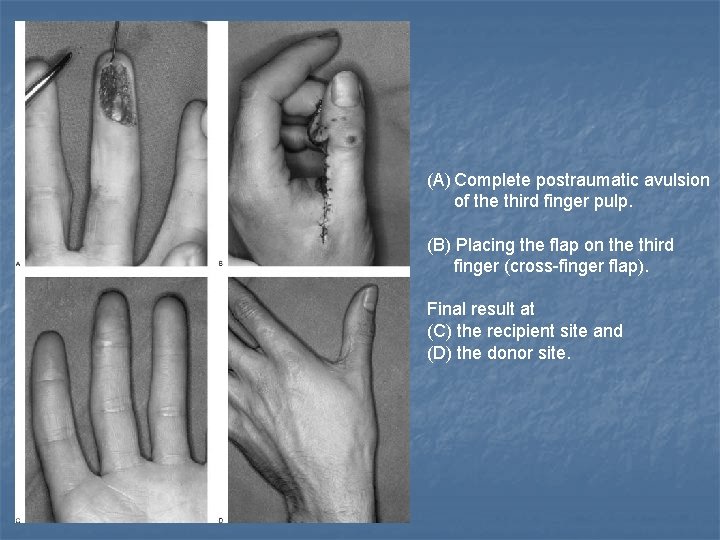 (A) Complete postraumatic avulsion of the third finger pulp. (B) Placing the flap on