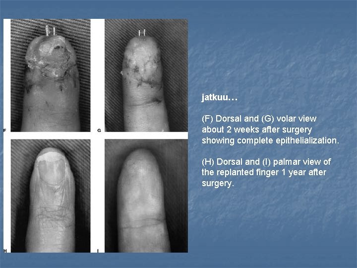 jatkuu… (F) Dorsal and (G) volar view about 2 weeks after surgery showing complete