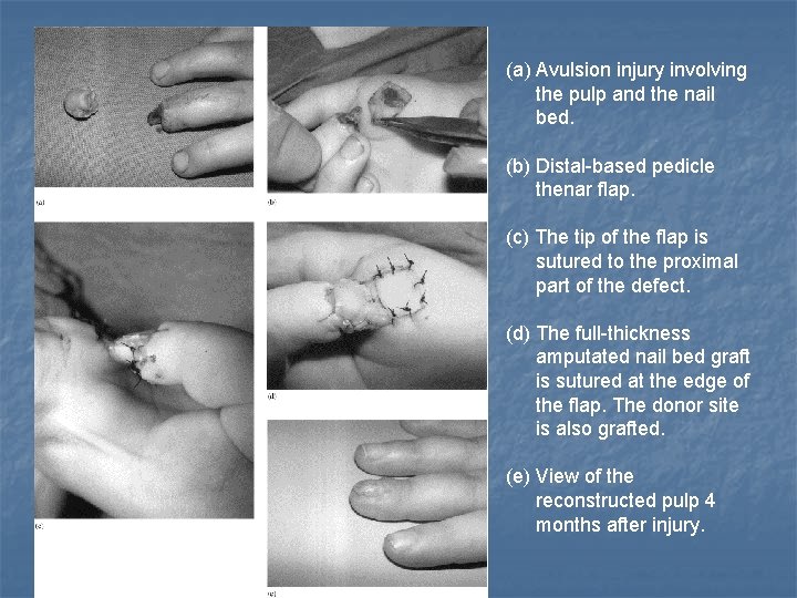 (a) Avulsion injury involving the pulp and the nail bed. (b) Distal-based pedicle thenar