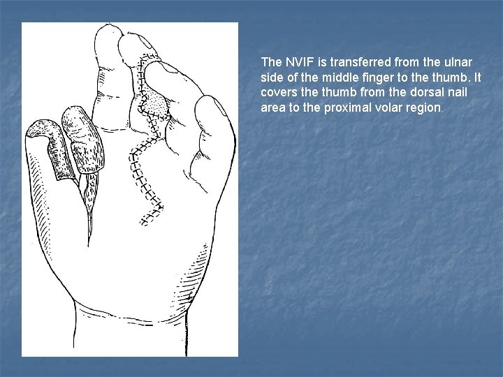 The NVIF is transferred from the ulnar side of the middle finger to the