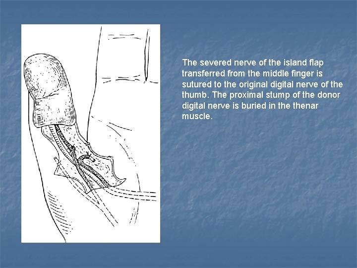 The severed nerve of the island flap transferred from the middle finger is sutured