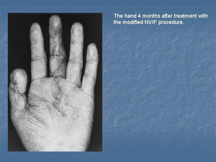 The hand 4 months after treatment with the modified NVIF procedure. 