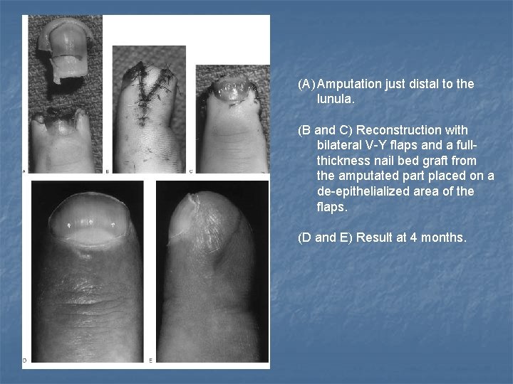 (A) Amputation just distal to the lunula. (B and C) Reconstruction with bilateral V-Y