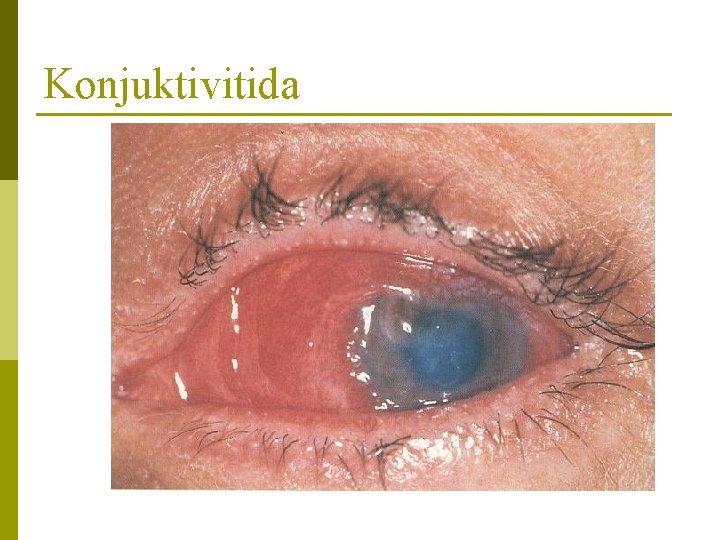 Konjuktivitida 