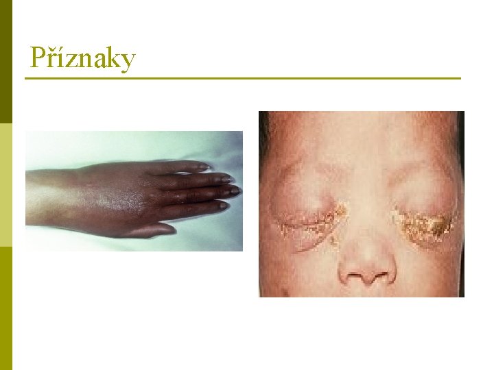 Příznaky 