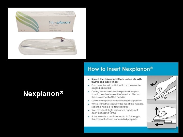 Nexplanon 