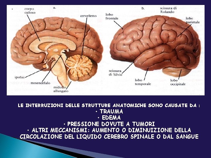 LE INTERRUZIONI DELLE STRUTTURE ANATOMICHE SONO CAUSATE DA : • TRAUMA • EDEMA •