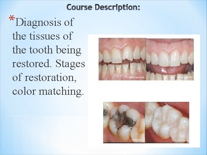 *Diagnosis of the tissues of the tooth being restored. Stages of restoration, color matching.