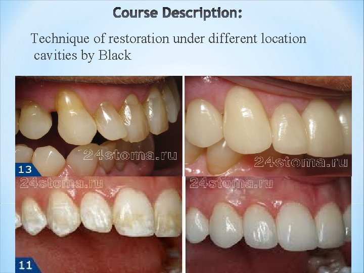 Technique of restoration under different location cavities by Black 