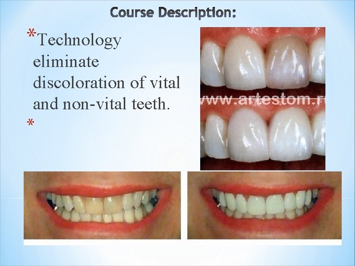 *Technology eliminate discoloration of vital and non-vital teeth. * 