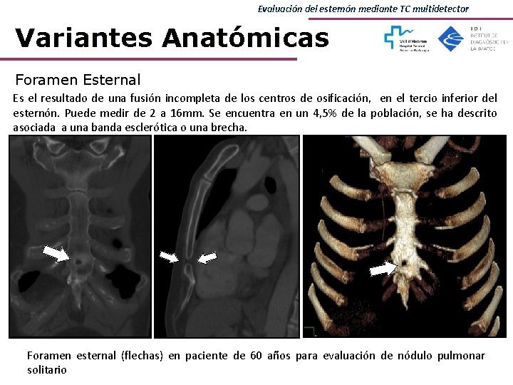 Evaluación del esternón mediante TC multidetector Variantes Anatómicas Foramen Esternal Es el resultado de Evaluación del esternón mediante TC multidetector Variantes Anatómicas Foramen Esternal Es el resultado de