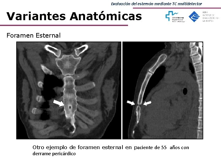 Evaluación del esternón mediante TC multidetector Variantes Anatómicas Foramen Esternal Otro ejemplo de foramen Evaluación del esternón mediante TC multidetector Variantes Anatómicas Foramen Esternal Otro ejemplo de foramen