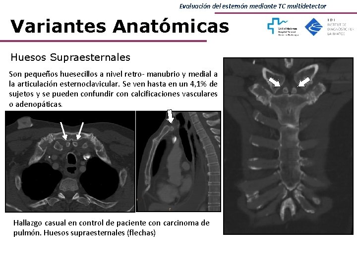 Evaluación del esternón mediante TC multidetector Variantes Anatómicas Huesos Supraesternales Son pequeños huesecillos a Evaluación del esternón mediante TC multidetector Variantes Anatómicas Huesos Supraesternales Son pequeños huesecillos a