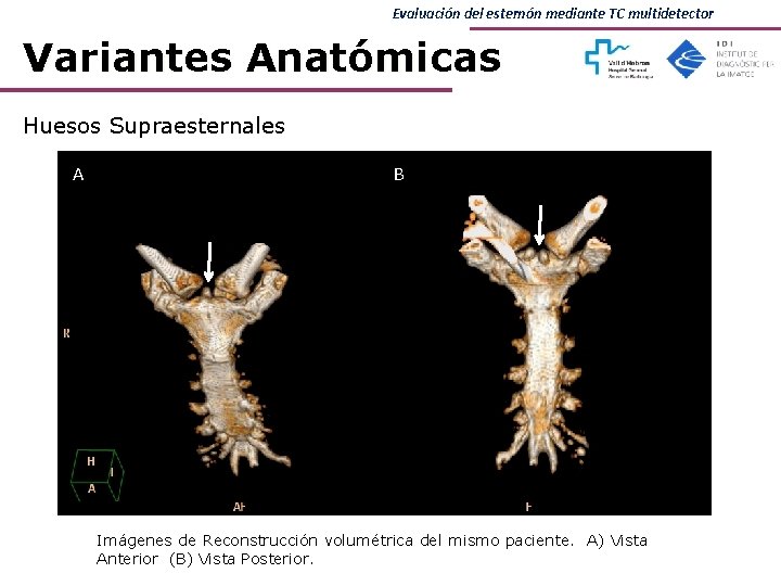 Evaluación del esternón mediante TC multidetector Variantes Anatómicas Huesos Supraesternales A B Imágenes de Evaluación del esternón mediante TC multidetector Variantes Anatómicas Huesos Supraesternales A B Imágenes de