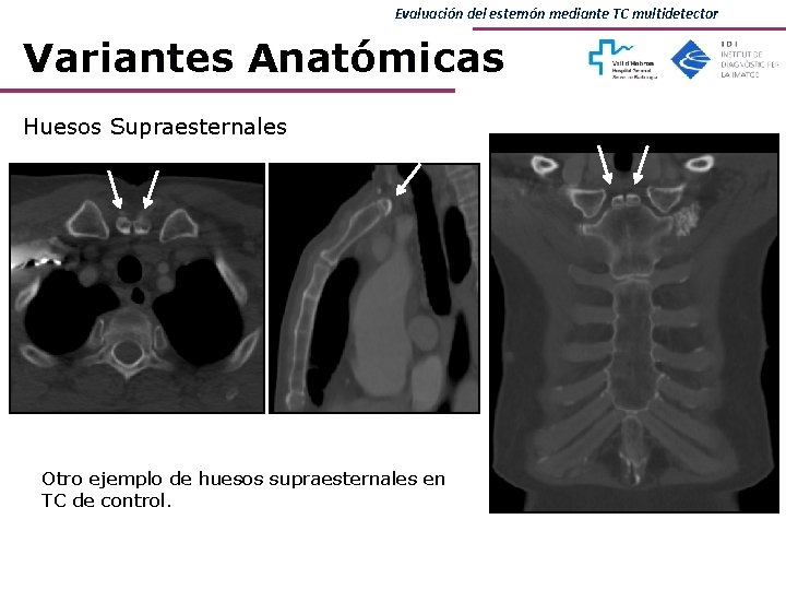 Evaluación del esternón mediante TC multidetector Variantes Anatómicas Huesos Supraesternales Otro ejemplo de huesos Evaluación del esternón mediante TC multidetector Variantes Anatómicas Huesos Supraesternales Otro ejemplo de huesos