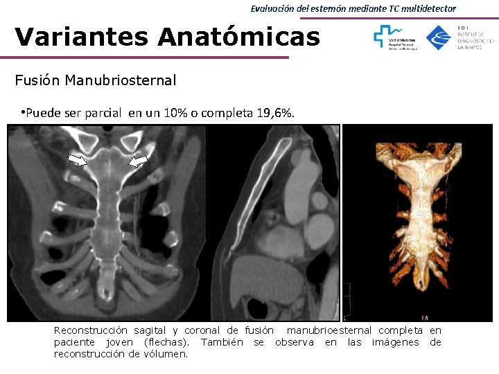Evaluación del esternón mediante TC multidetector Variantes Anatómicas Fusión Manubriosternal • Puede ser parcial Evaluación del esternón mediante TC multidetector Variantes Anatómicas Fusión Manubriosternal • Puede ser parcial