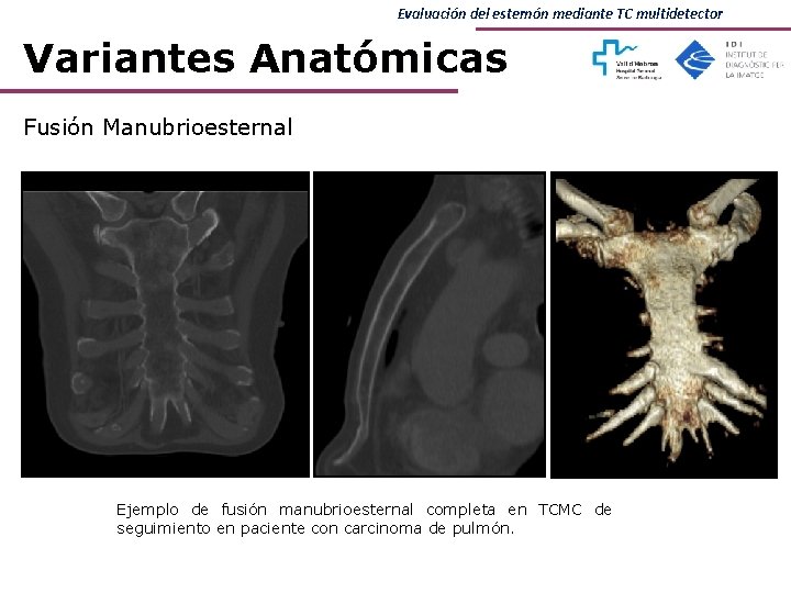 Evaluación del esternón mediante TC multidetector Variantes Anatómicas Fusión Manubrioesternal Ejemplo de fusión manubrioesternal Evaluación del esternón mediante TC multidetector Variantes Anatómicas Fusión Manubrioesternal Ejemplo de fusión manubrioesternal