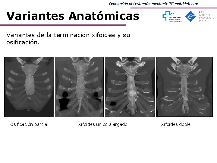 Evaluación del esternón mediante TC multidetector Variantes Anatómicas Variantes de la terminación xifoidea y Evaluación del esternón mediante TC multidetector Variantes Anatómicas Variantes de la terminación xifoidea y