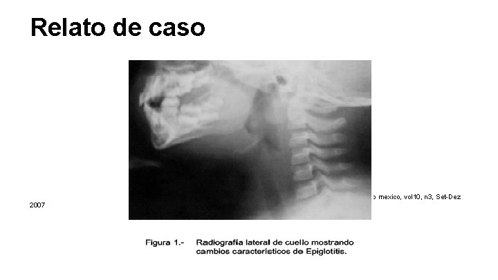 Relato de caso Arquivos de investigação pediatrica do mexico, vol 10, n 3, Set-Dez