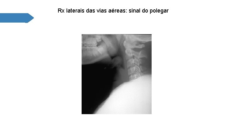 Rx laterais das vias aéreas: sinal do polegar 