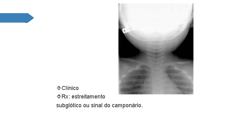  Clínico Rx: estreitamento subglótico ou sinal do camponário. 