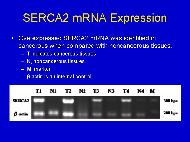 SERCA 2 m. RNA Expression • Overexpressed SERCA 2 m. RNA was identified in