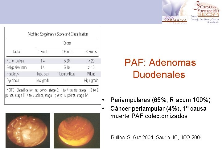PAF: Adenomas Duodenales • Periampulares (65%, R acum 100%) • Cáncer periampular (4%), 1ª