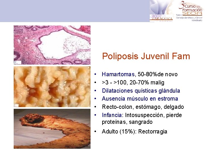 Poliposis Juvenil Fam • • • Hamartomas, 50 -80%de novo >3 - >100, 20